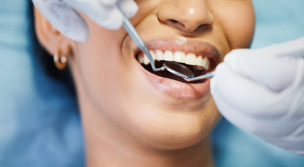 Best Emergency Wisdom Teeth Removal in Hercules, CA