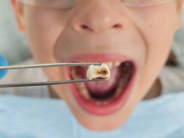 Best Emergency Treatment for Toothache in Hercules, CA